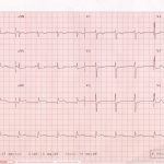 inferior ST-elevation myocardial infarction