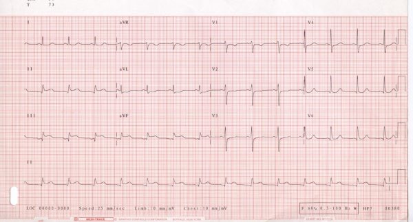 Inferior ST-Elevation Myocardial Infarction: A Real Concern