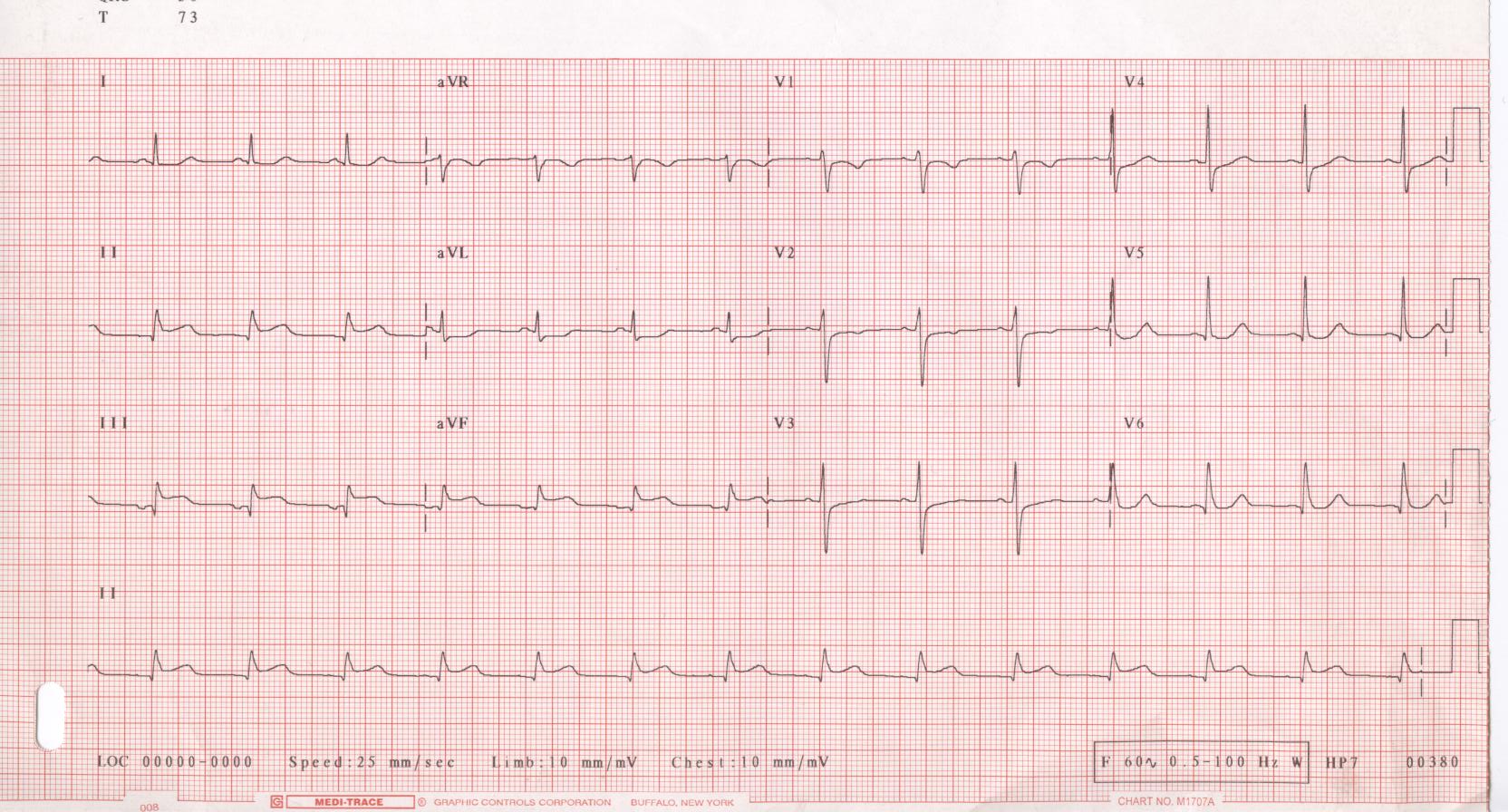 inferior ST-elevation myocardial infarction